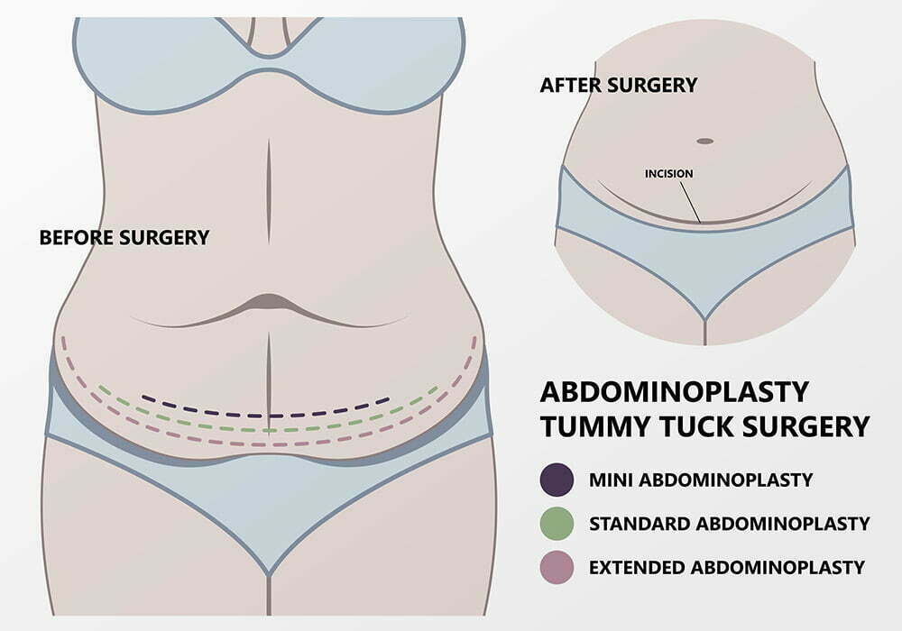 Tummy Tuck Miami 4000 Best Price Boutinic Aesthetics 0098