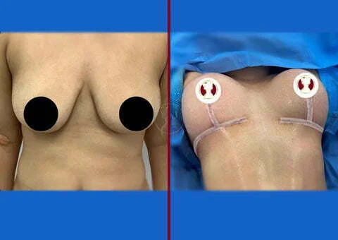 breast lift and augmentation before and after case 15