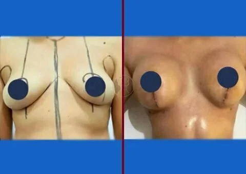 breast lift and augmentation before and after case 13
