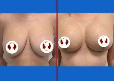 breast lift before and after case 14