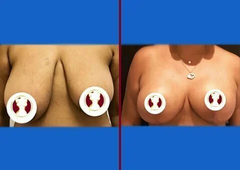 breast lift before and after case 8