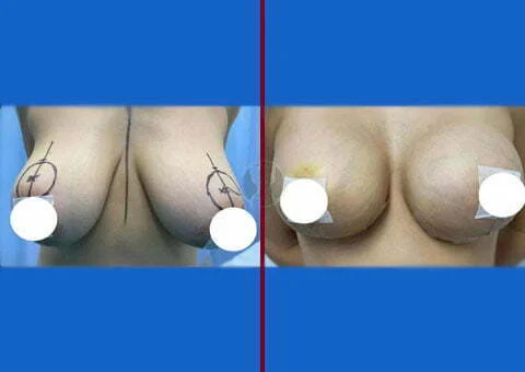 breast lift with implants before and after 16