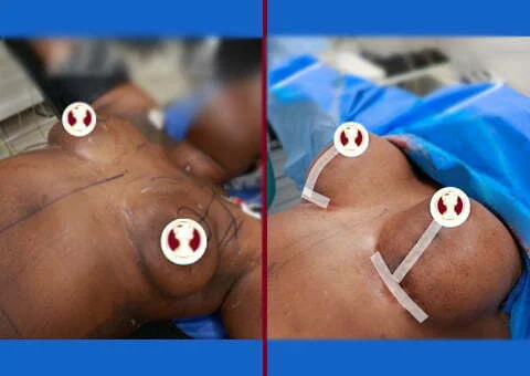 breast lift with implants before and after case 3