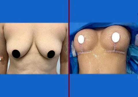 breast lift with saline implants before and after 11