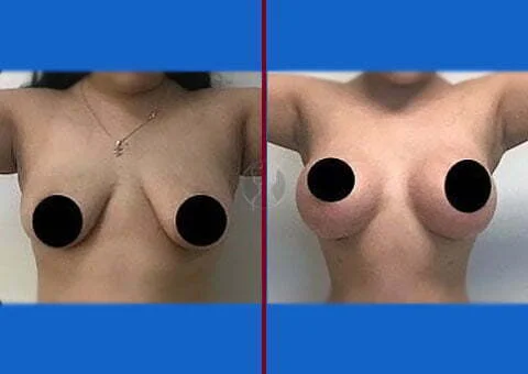 breast lift with saline implants before and after 12