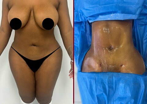 Liposuction Before and After