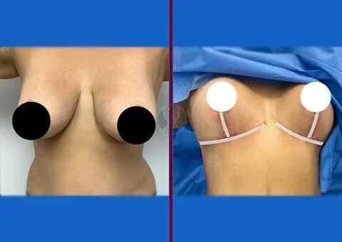 mastopexy before and after case 9