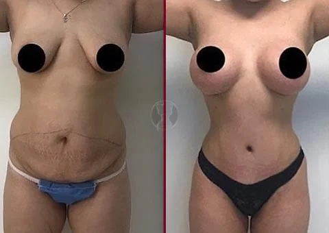 mommy makeover before and after 12