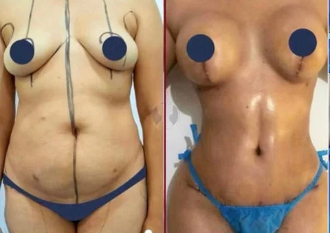 mommy makeover before and after 13