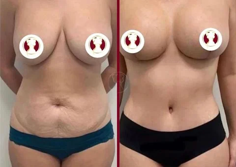 mommy makeover before and after 14
