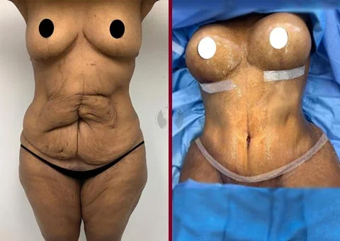 mommy makeover before and after case 10
