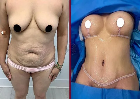mommy makeover before and after case 11