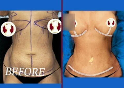 mommy makeover before and after case 8