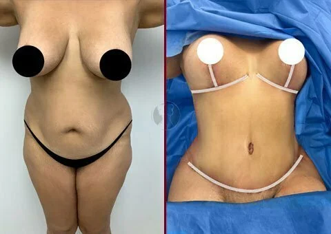 mommy makeover before and after case 9
