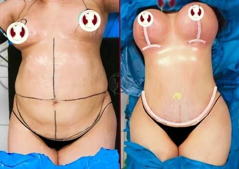 mommy makeover before and after patient 2