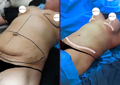 mommy makeover before and after patient 5