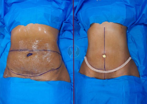 Before & After Abdominoplasty 24 Photos