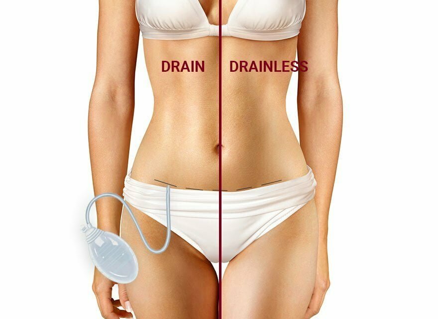 drainless tummy tuck in miami