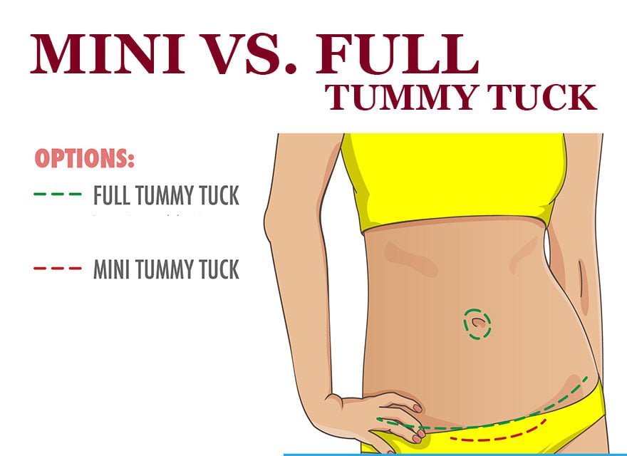 Mini tummy tuck vs full tummy tuck