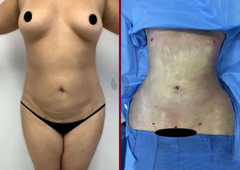 Lipo 360, Mons Pubis w/ Excision, Before and After, Dr. Gartner