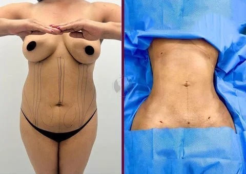 abdominal liposuction before and after case 26