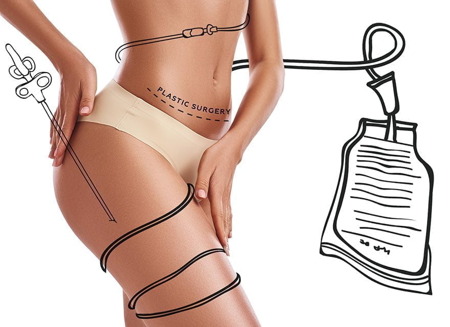 Benefits of Liposuction for Body Contouring