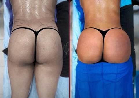 buttock fat grafting before after pat 29