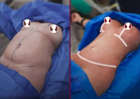 mommy makeover pat17 before after picture