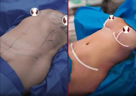 mommy makeover before and after photo patient 16