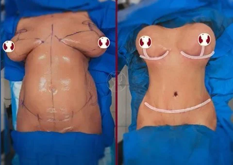 mommy makeover miami before and after pat15