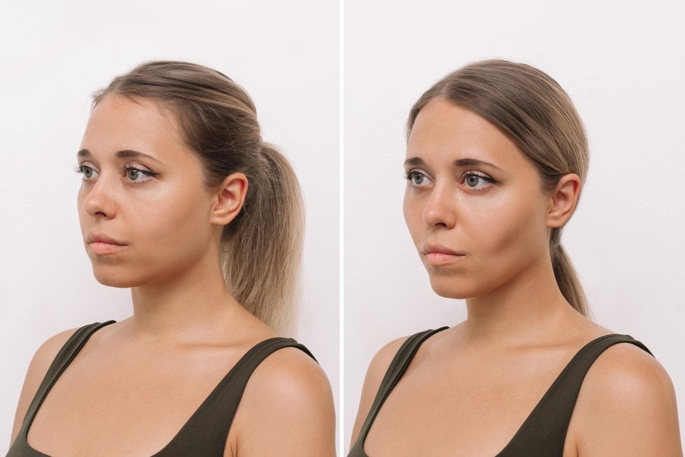Buccal Fat Removal And Chin Lipo Cost Effective Solutions