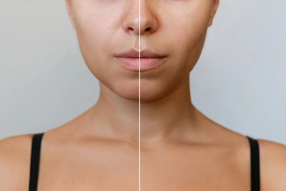 Buccal fat removal cost Chicago