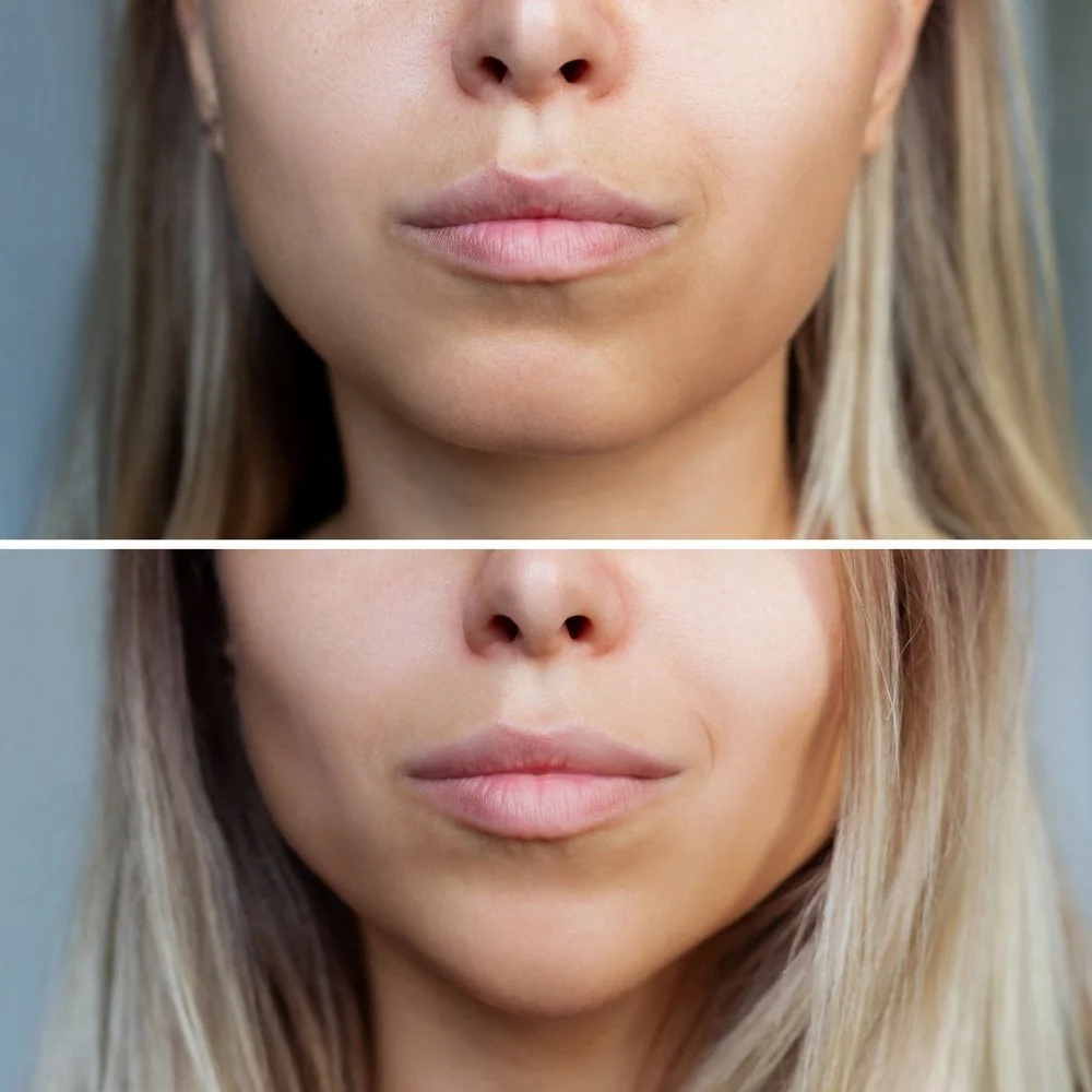 Buccal fat removal cost México