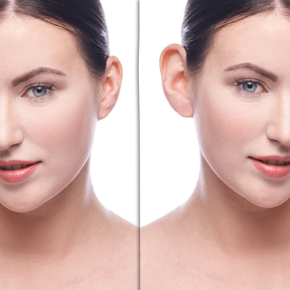 Buccal fat removal cost Tampa
