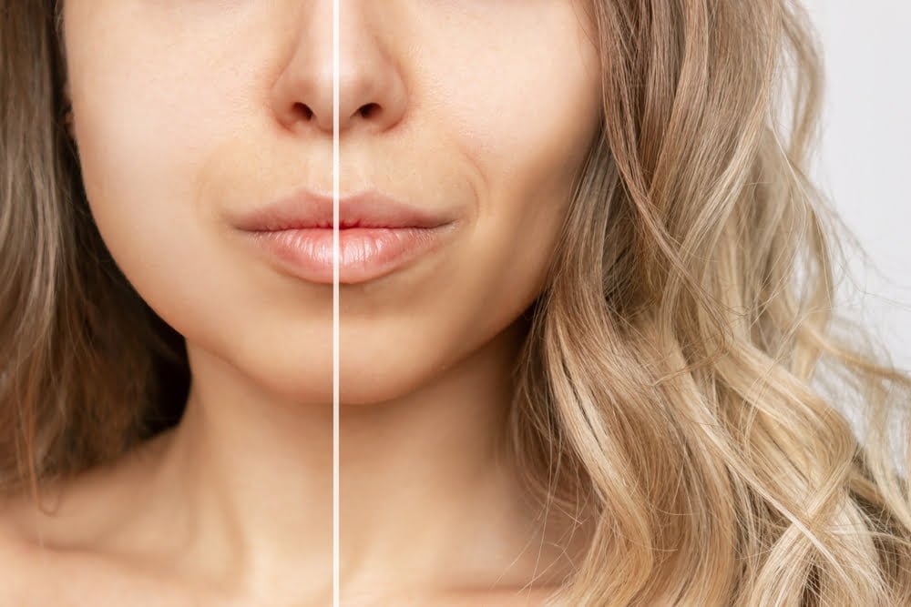 Buccal fat removal recovery