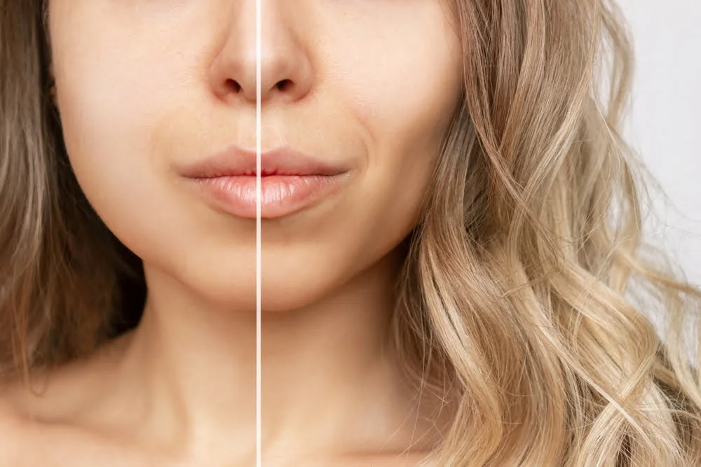 Buccal fat removal recovery