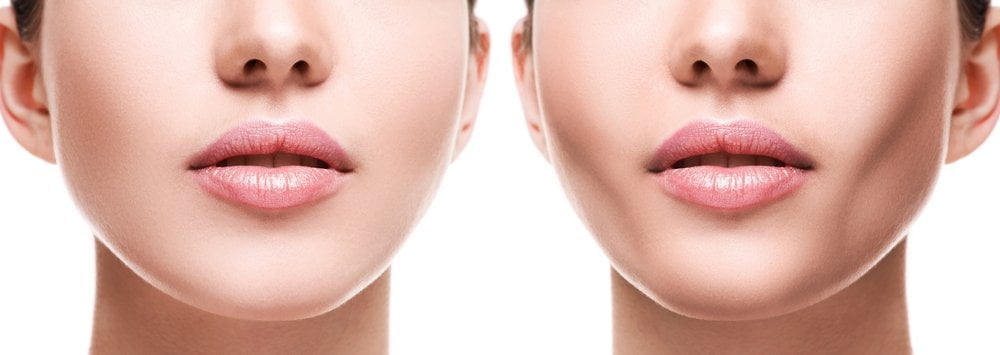 Factors Affecting the Cost of Buccal Fat Removal in Mexico