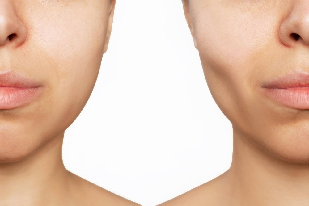 Factors Influencing Buccal Fat Removal Cost