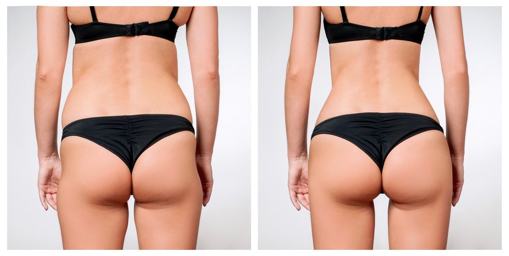 Miami pubic liposuction