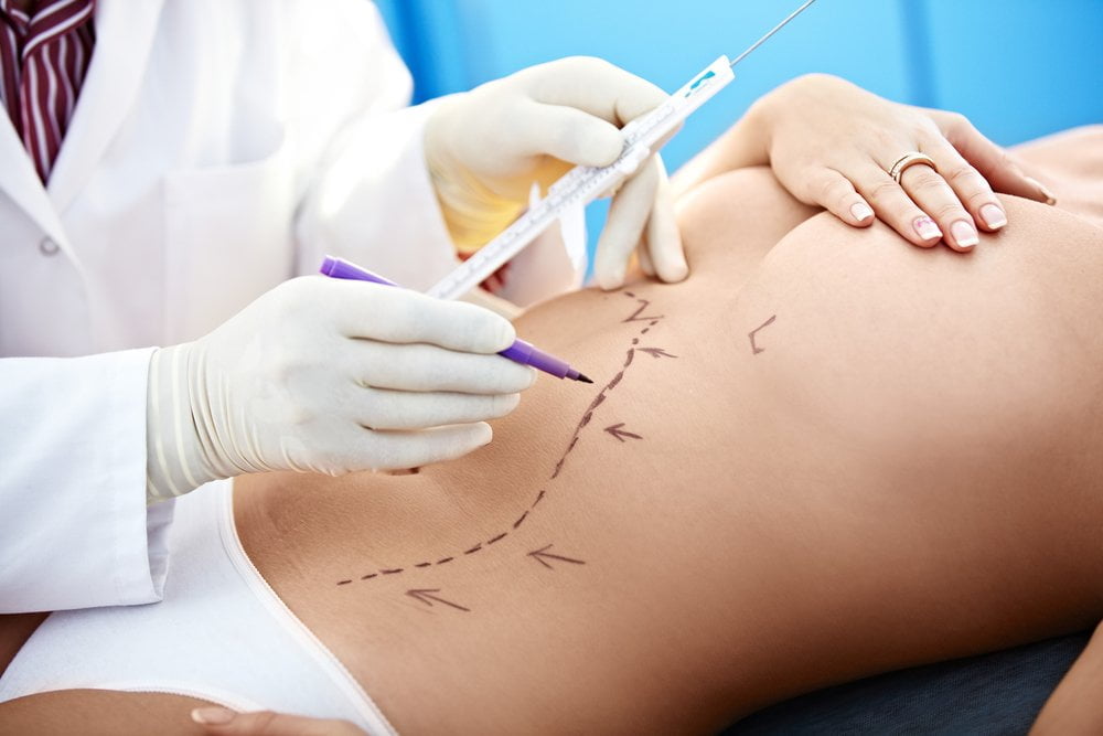Vaser lipo recovery